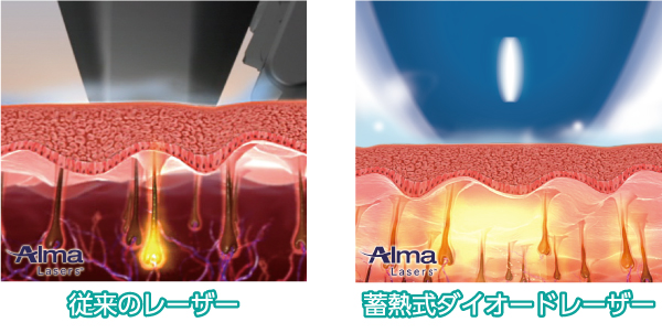 医療レーザー 脱毛 エステ 永久脱毛 レーザー脱毛 ダイオード ソプラノ ジェントル