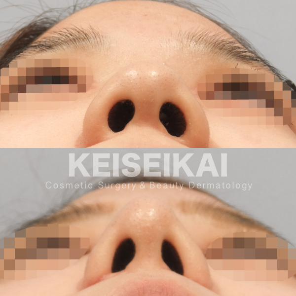鼻尖形成 小鼻縮小 中間法 症例写真 恵聖会クリニック