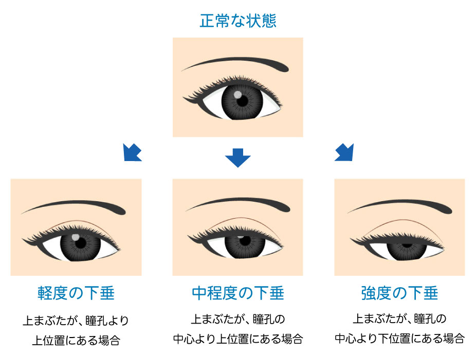 眼瞼下垂の軽度中程度強度の症状を表したイラスト