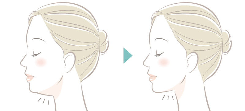 ペリカン手術のbefore、After写真イメージ