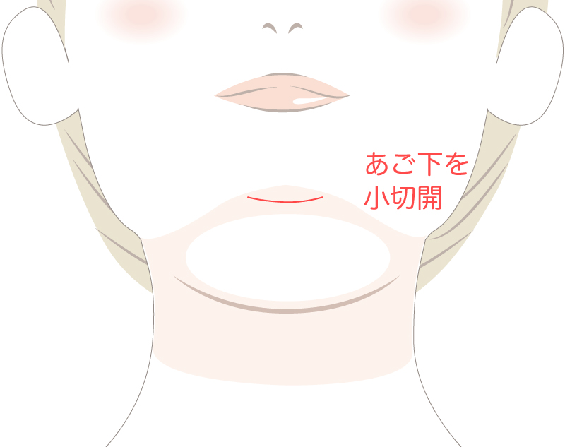 ペリカン手術の流れ1