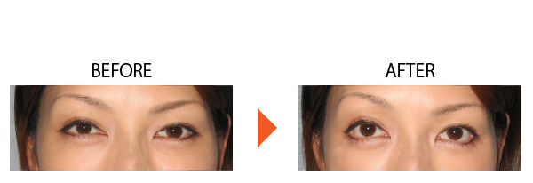 下眼瞼下制術 たれ目 垂れ目 目を大きくする 症例