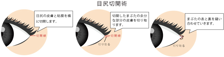 目尻切開イメージ画像