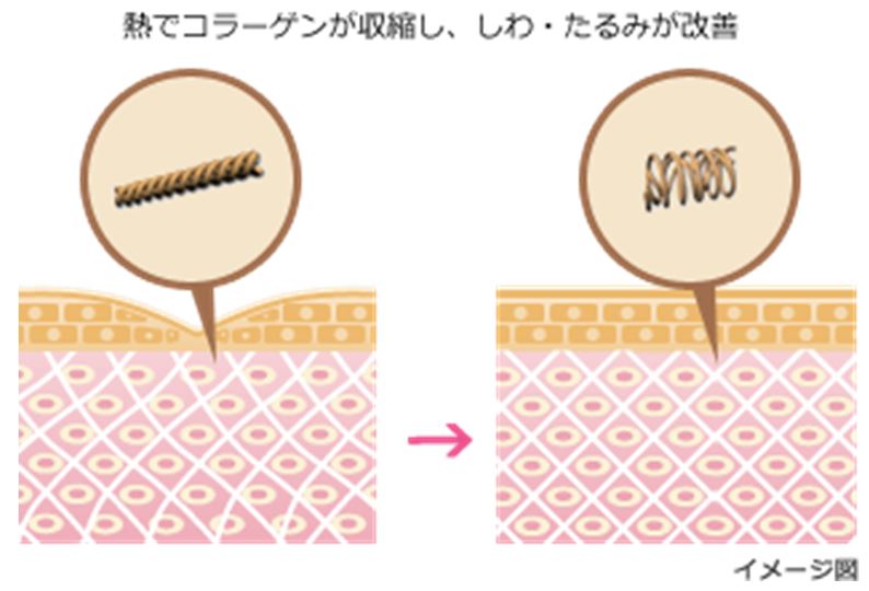 イントラジェン gfr リフトアップ ハリ しわ たるみ 大阪