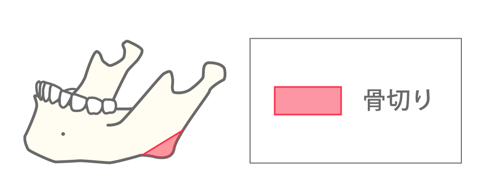 エラ削り（下顎角骨切り）従来のエラ削りのイメージイラスト