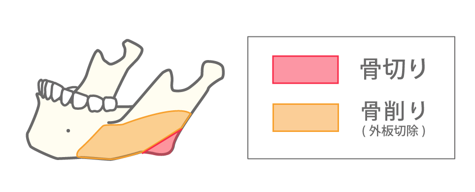 拡大下顎角形成（下顎角骨切り＋下顎枝・体部外板切除）のイメージイラスト