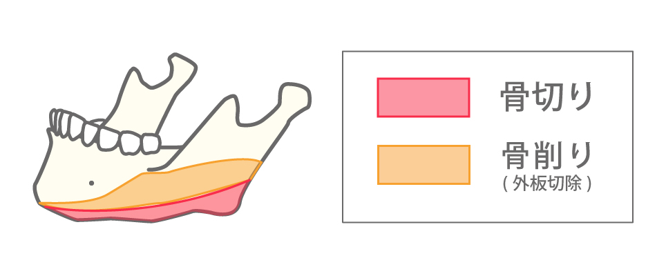 下顎輪郭全周骨切りのイメージイラスト