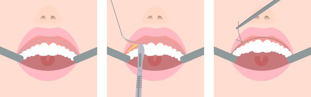 上口唇粘膜切除術