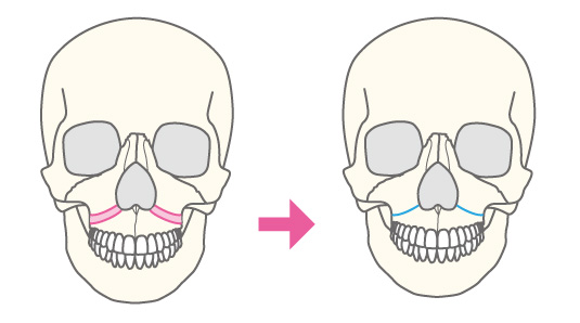 ルフォー（LeFortI型）骨切り術（中顔面短縮術）