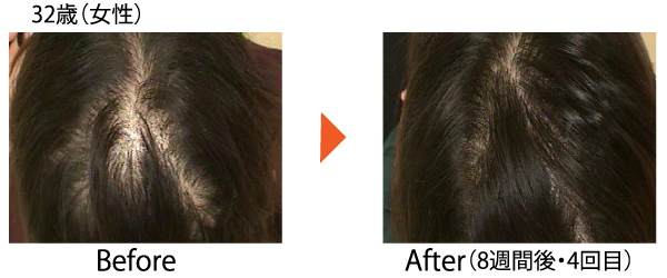 Dr.CYJ ヘアフィラー 毛髪再生 AGA ハゲ治療 発毛 育毛 薄毛 世界初 ハイブリッドペプチド 症例