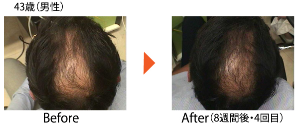 Dr.CYJ ヘアフィラー 毛髪再生 AGA ハゲ治療 発毛 育毛 薄毛 世界初 ハイブリッドペプチド 症例