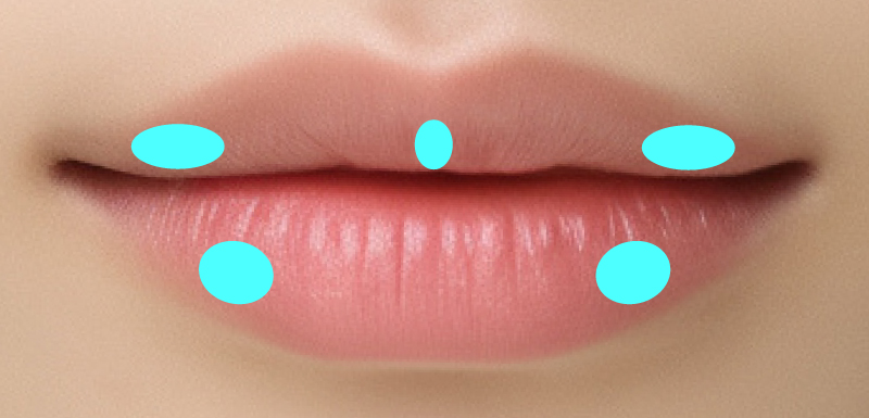 M字リップの注入箇所