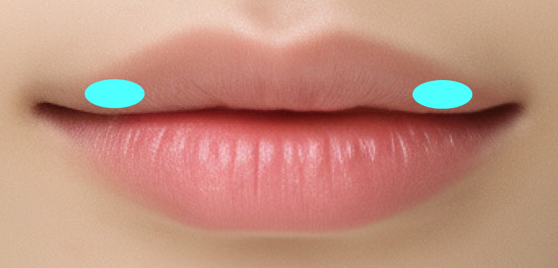 アヒル口の注入箇所