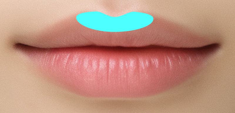 切らない人中短縮（リップリフト）の注入箇所