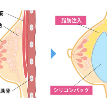 ハイブリッド豊胸