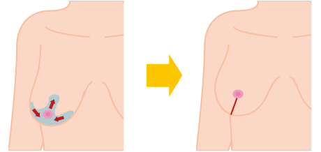 乳房縮小 吊り上げ 大阪 女性特有の悩み