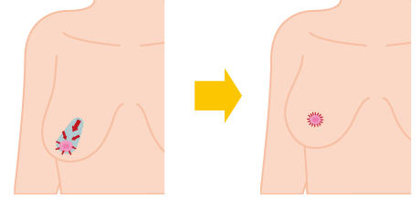 乳房縮小 吊り上げ 大阪 女性特有の悩み