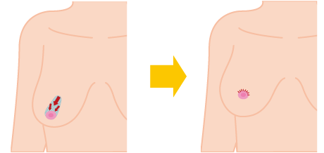 乳房縮小 吊り上げ 大阪 女性特有の悩み