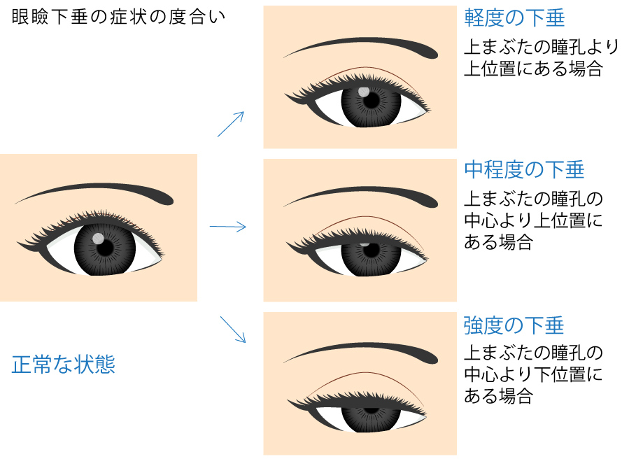 眼瞼下垂 恵聖会クリニック 保険 二重まぶた まぶたのたるみ取り