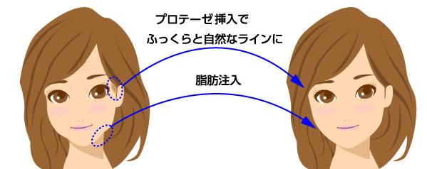 こめかみ へこみ くぼみ プロテーゼ 大阪 こめかみライン 脂肪注入