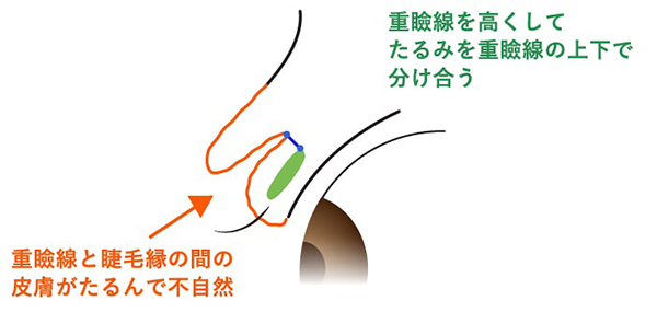 高い位置で重瞼を作ることにより重瞼線と睫毛縁の間の皮膚がたるんで不自然になる場合を示す図