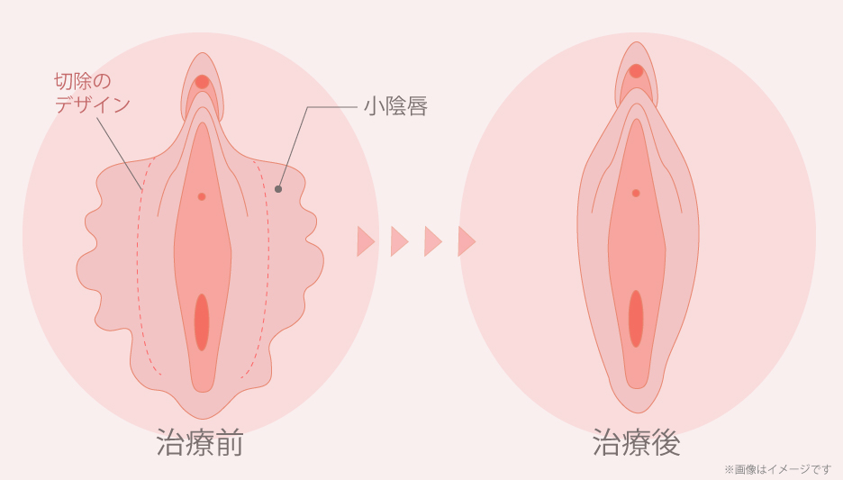 小陰唇縮小術のイメージ図