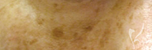 肝斑の写真