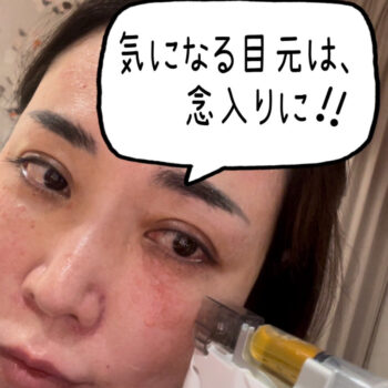 PRP 水光注射をする小西Dr.の写真