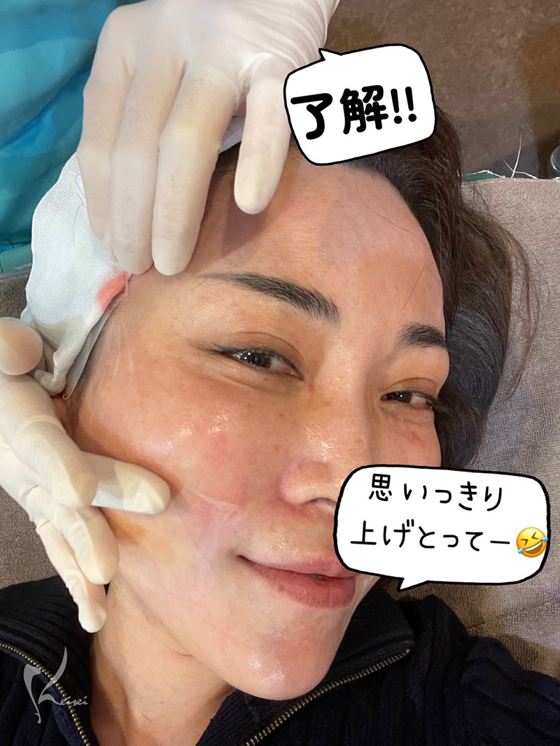 小西医師の糸リフト施術時の写真