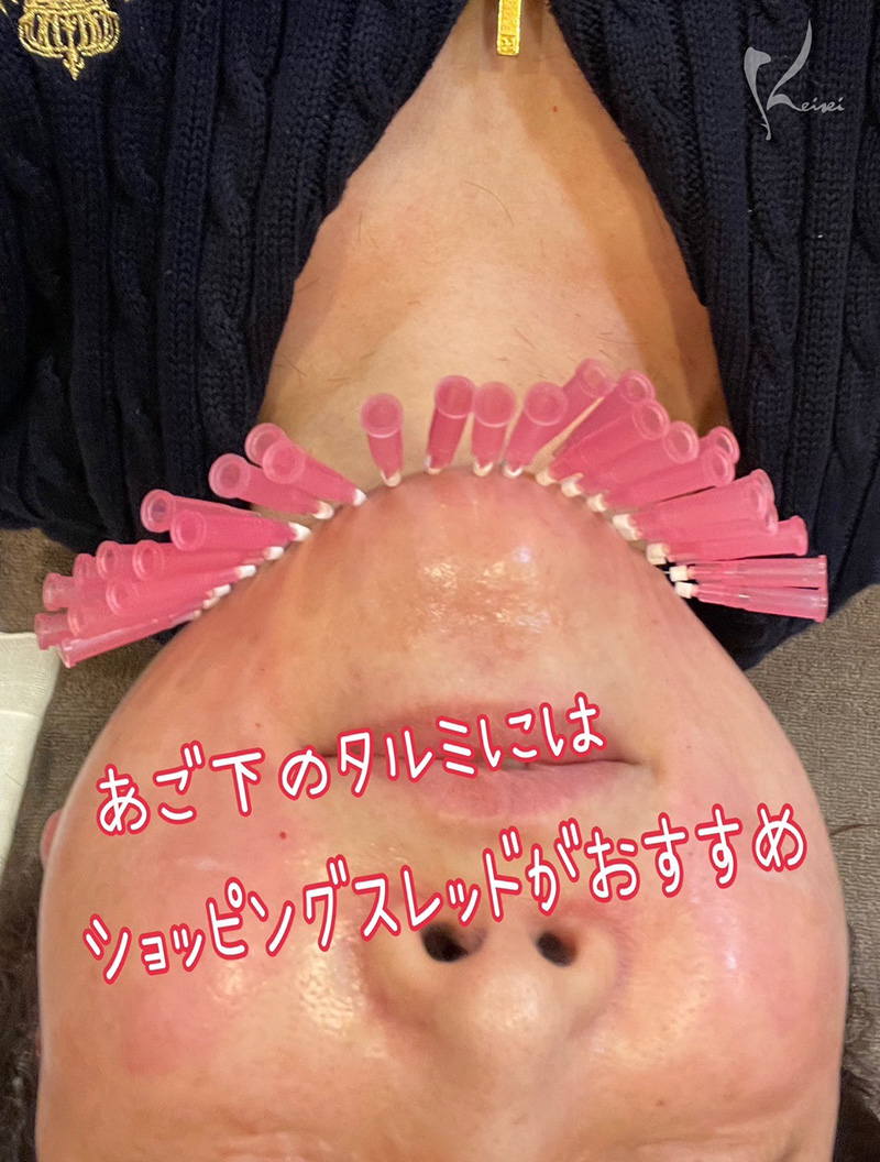 顎下のショッピングスレッド施術時の写真