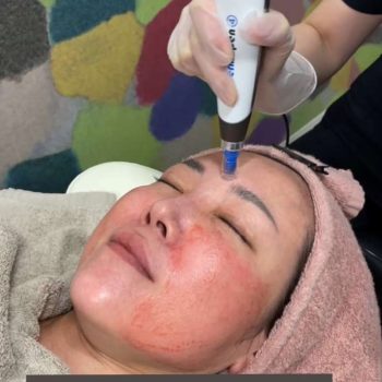 ヴァンパイアフェイシャル ダーマペン4を受けている小西医師の写真