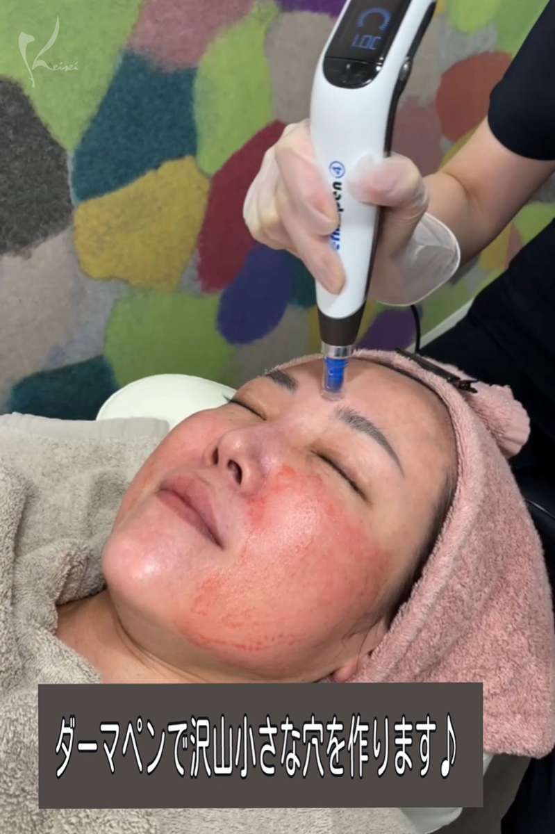 ヴァンパイアフェイシャル ダーマペン4を受けている小西医師の写真