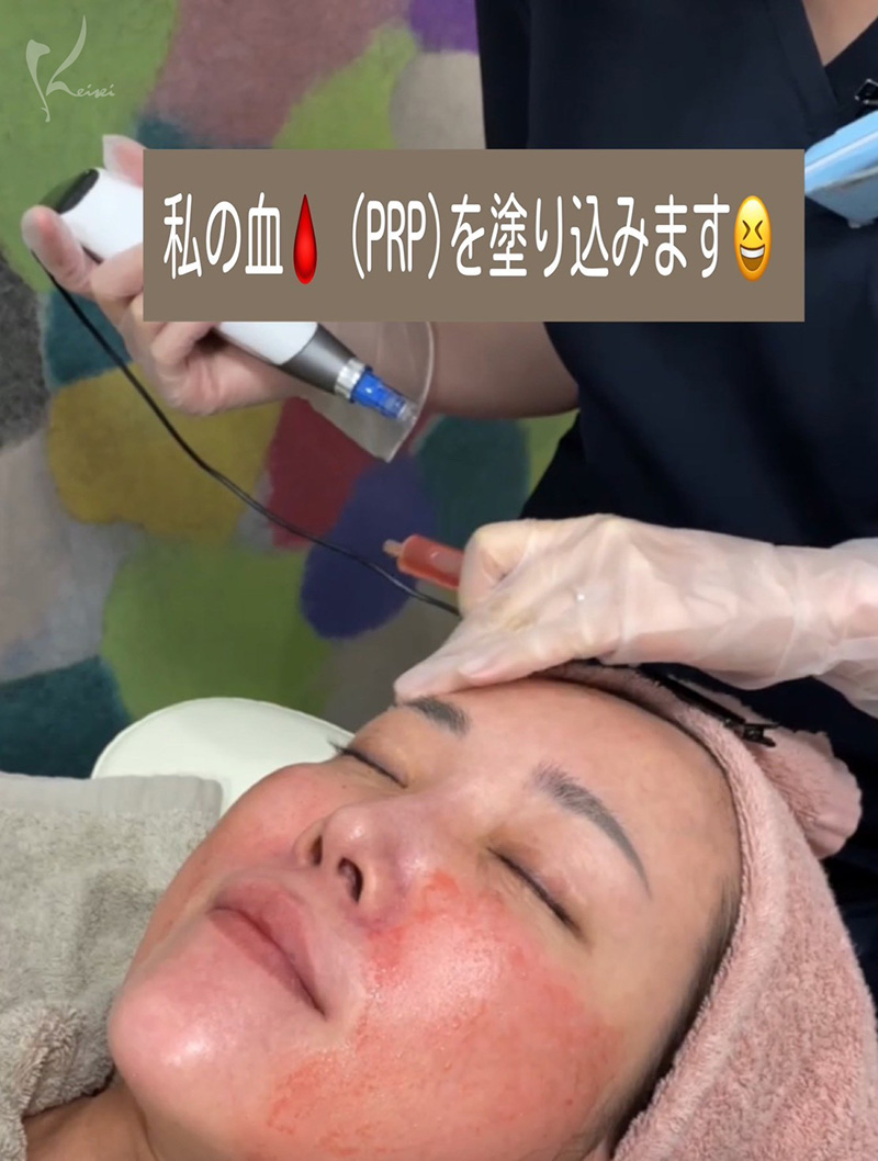 ヴァンパイアフェイシャル PRPを塗りこんでいる小西医師