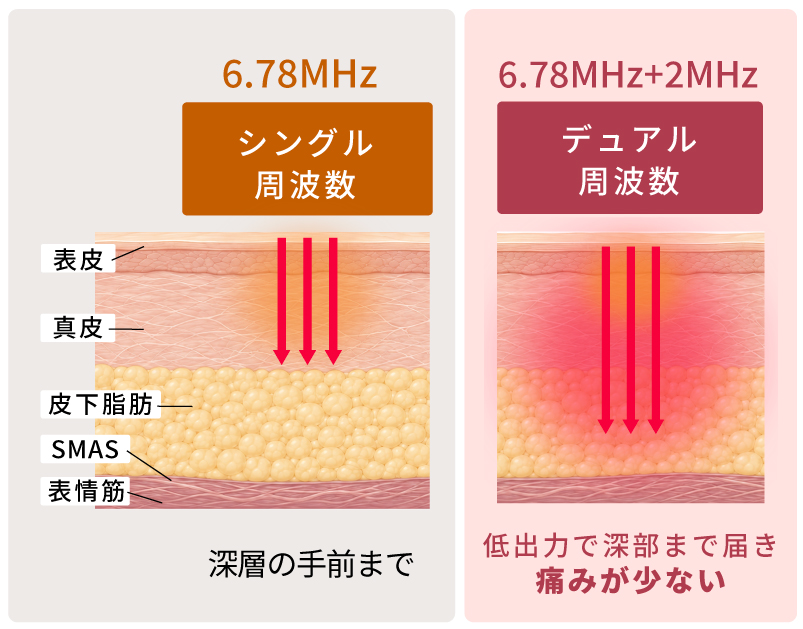 XERF（ザーフ）周波数　デュアル周波数