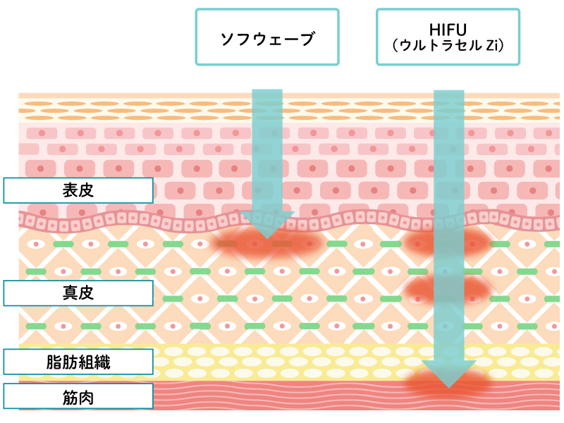 ソフウェーブとハイフ（HIFU／ウルトラセルZi）の違い