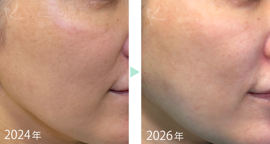 現在と2年前の小西医師の肌の様子