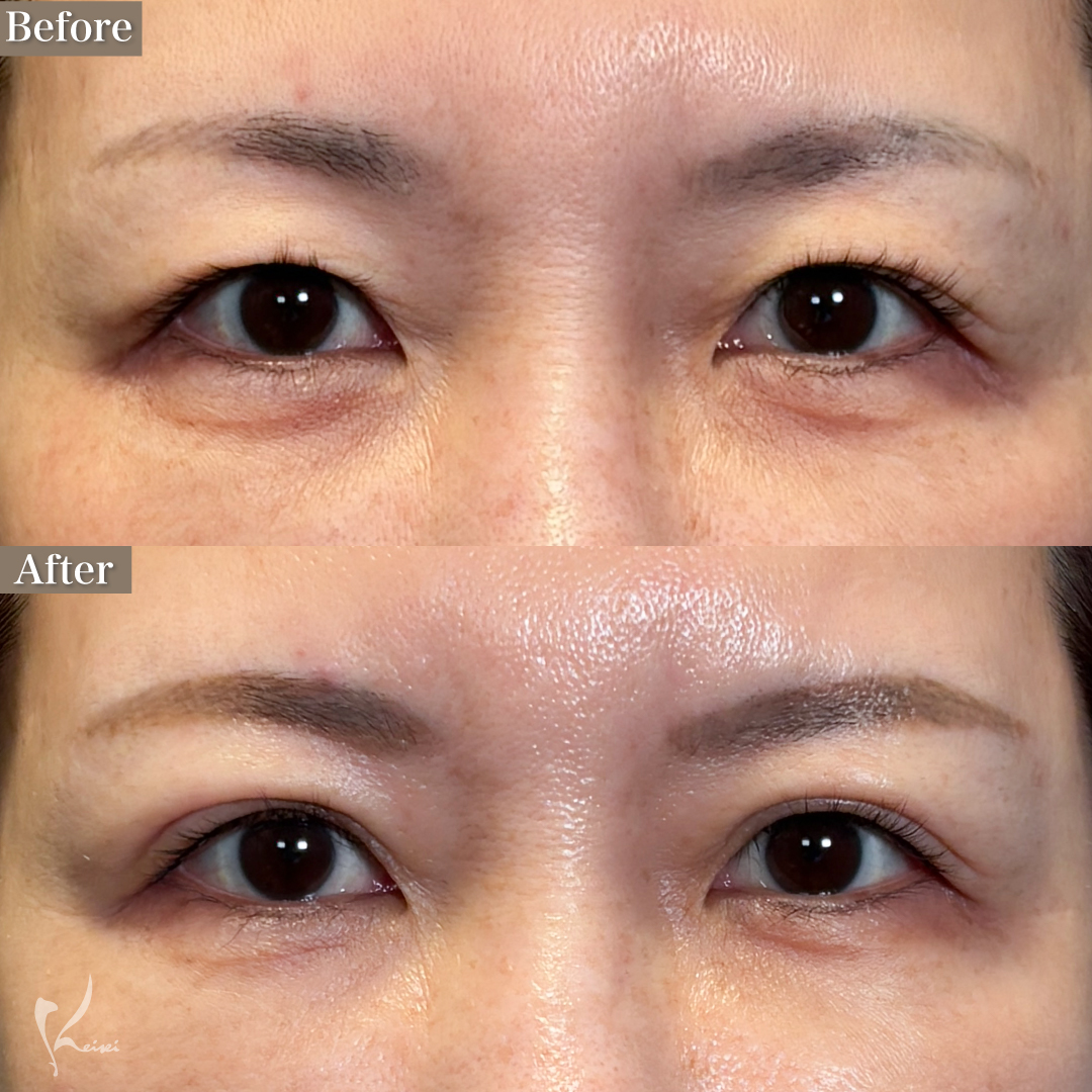 50代女性の埋没手術症例1