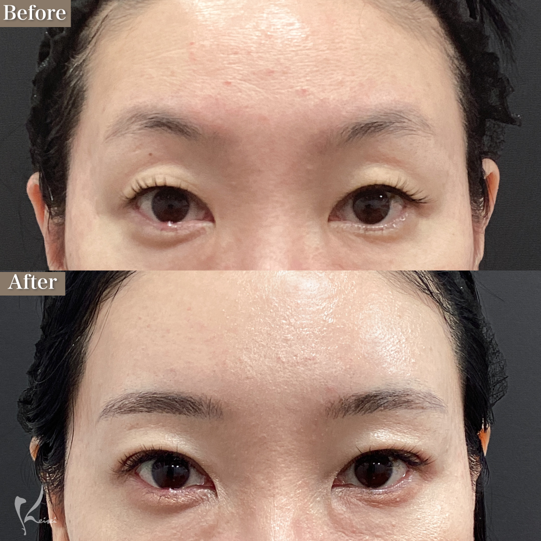 40代女性の埋没手術症例