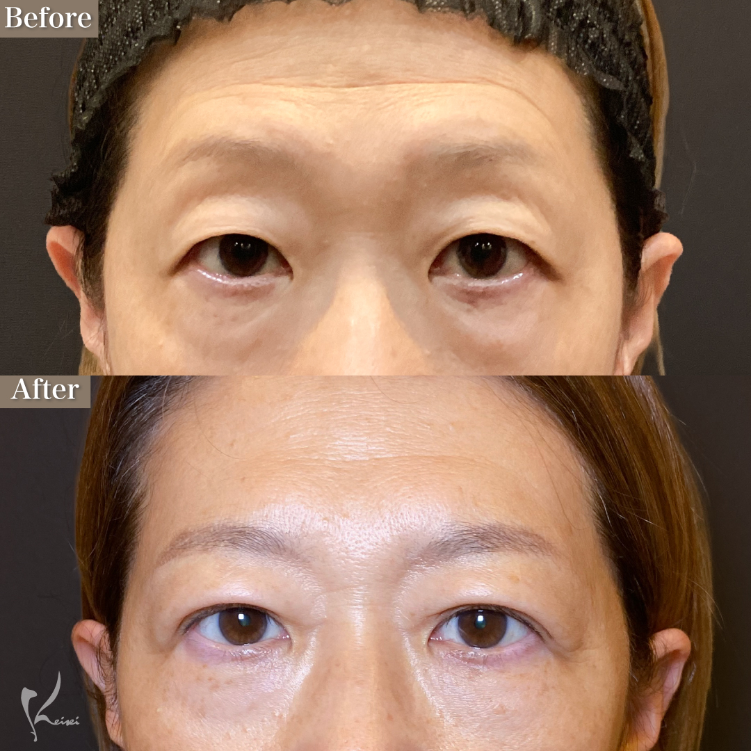 50代女性の埋没手術症例2