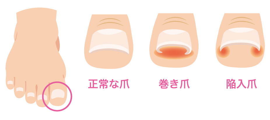 正常な爪・巻き爪・陥入爪の状態