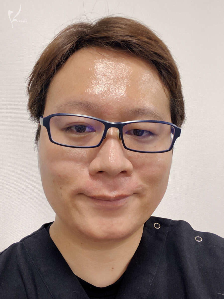 髭脱毛の画像