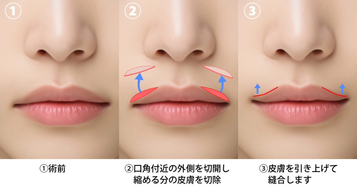 外側人中短縮術（上口唇挙上術）の概要イラスト