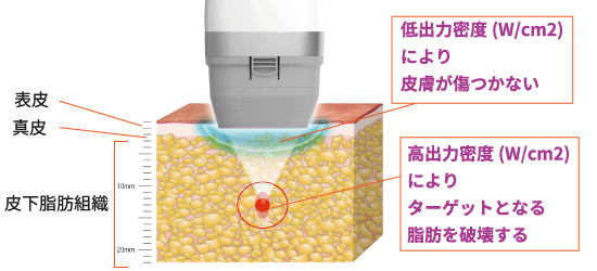 リポセル liposel 痩身 メディカルダイエット hifu バージョンアップ