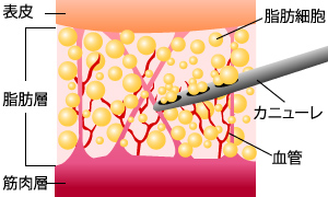 医療機関での痩身・ダイエット【脂肪吸引】