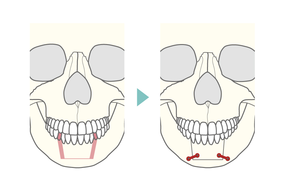 下顎分節骨切り術式の正面からのイメージ