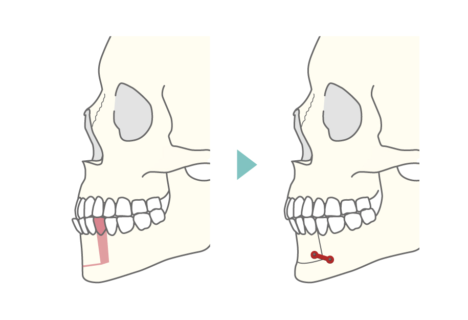 下顎分節骨切り術式の横からのイメージ