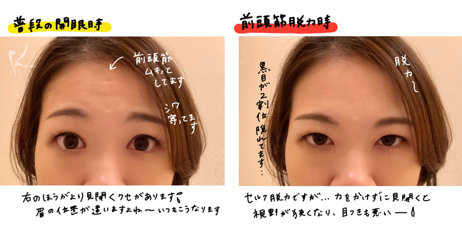 つるつるおでこのススメ 恵聖会クリニック 大阪の美容外科 美容皮膚科 つるつるおでこのススメ 恵聖会クリニック 大阪の美容外科 美容皮膚科