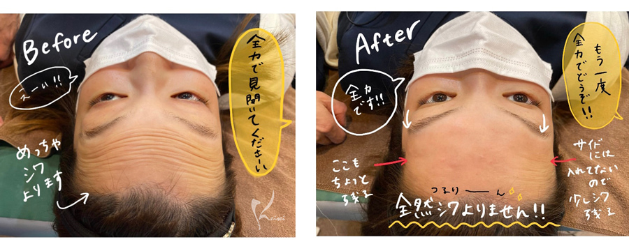額のヒアルロン酸注入前後の額の写真
