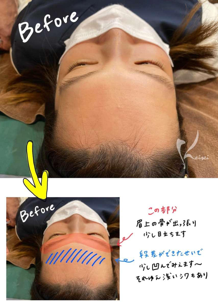 赤松さんヒアルロン酸注入前の写真