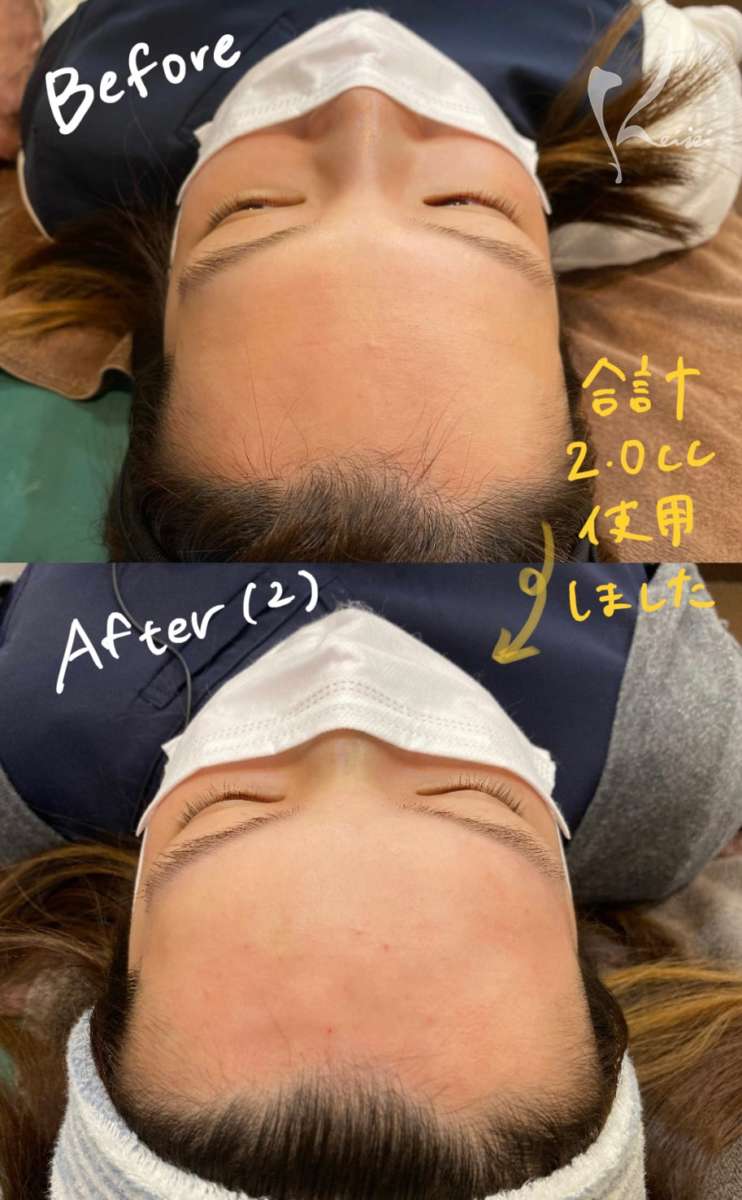 赤松さん1回目のヒアルロン酸注入前から2回目注入後の上からのビフォアーアフター写真